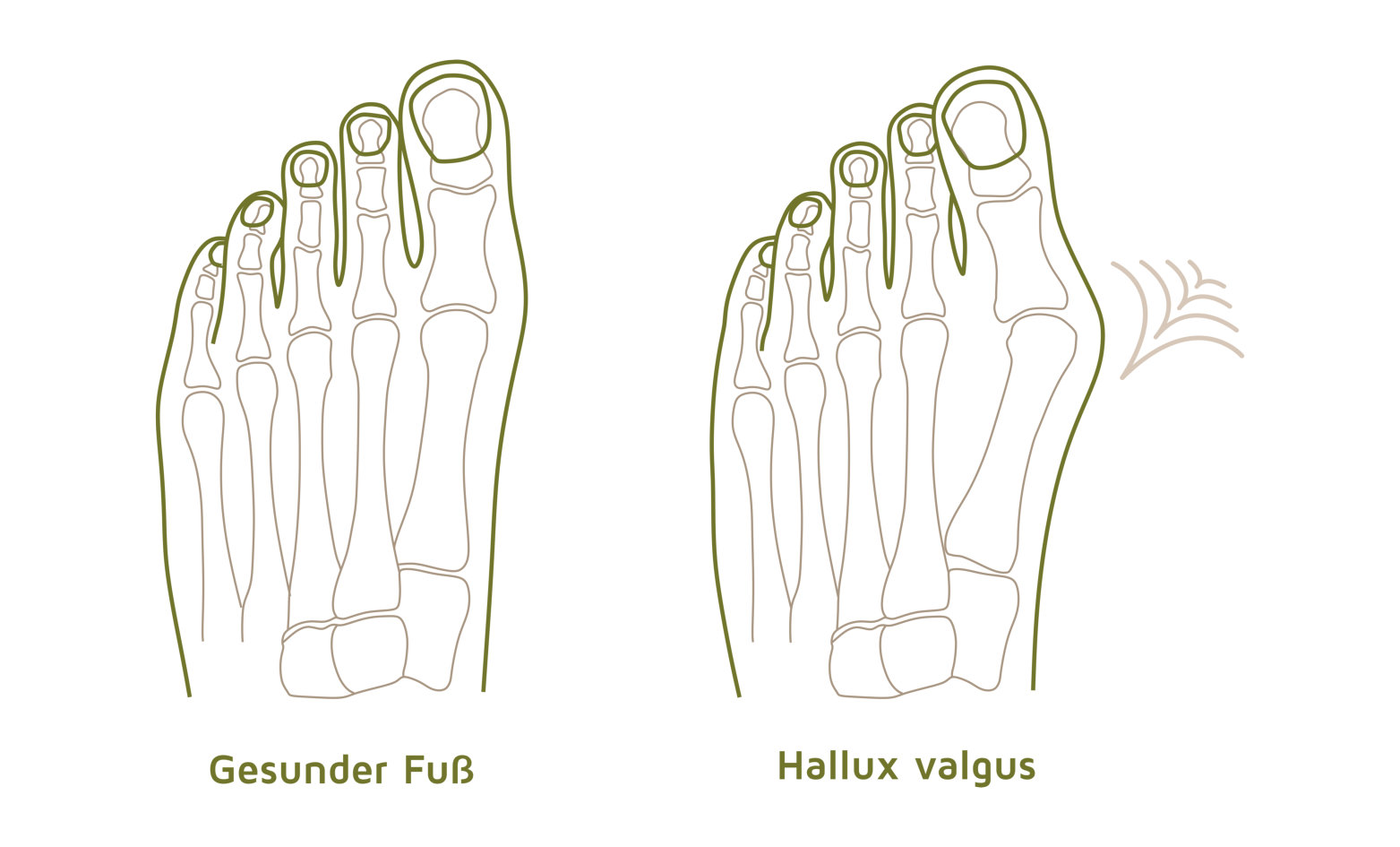 Hallux 2