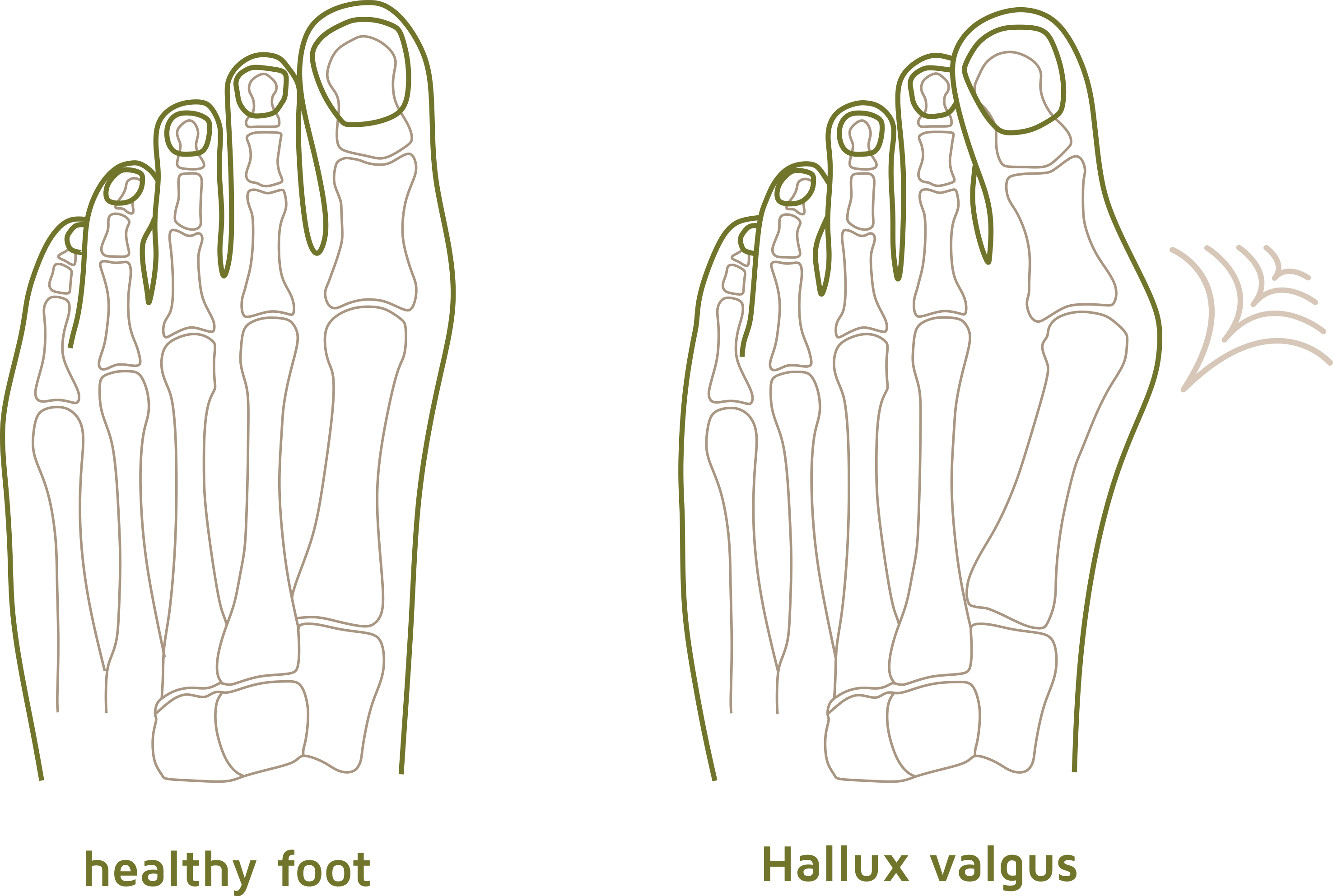 Hallux Valgus Darstellung (Englisch)1